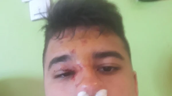 Da li su ovo povrede od udarca loptom u lice?, Pionirska liga RS, Istok - Liga za prvaka
